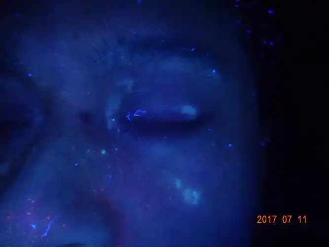 小小白斑,困扰了梁先生近10年然而初步问诊才知道,梁先生腿部的白斑在