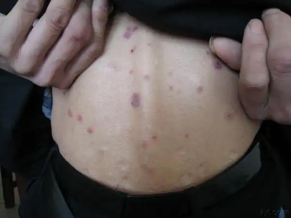 二期梅毒疹