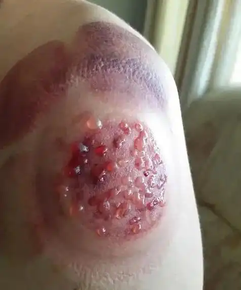 肩周炎,拔罐治疗有奇效!少有人知