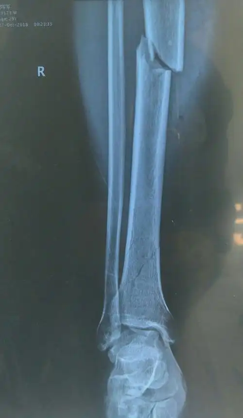 胫骨多段骨折,中段移位a3,远折端无移位