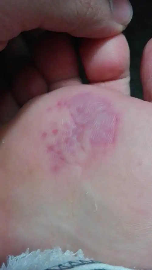 跑步前脚底用太大力,导致前脚底肿红肿红的,我的工