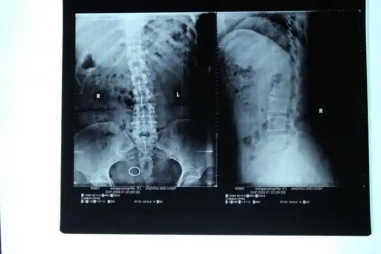 【元旦期间原创病例讨论】王某,女,48岁,摔伤后腰部疼痛,活动受限半