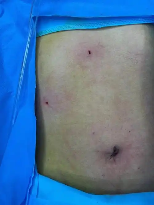 胆囊结石 - 好大夫在线