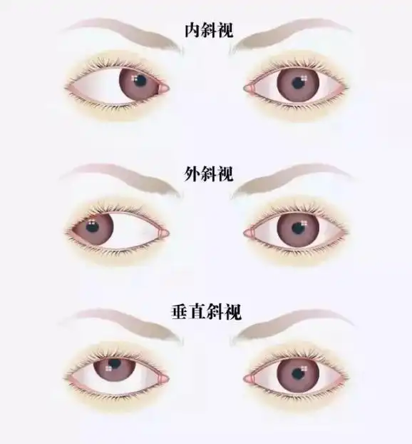 这样的斗鸡眼没关系是假性的