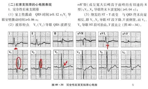 关于郭继鸿--心电图学:不完全性右束支阻滞 图例的一点疑问.