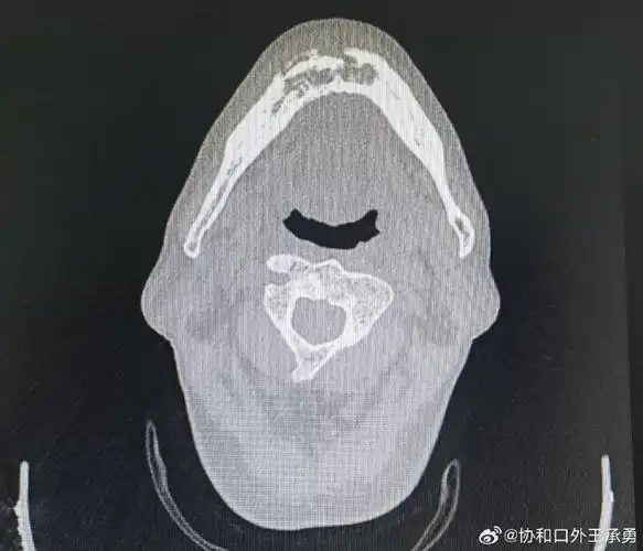 药物性颌骨骨髓炎