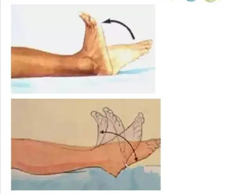 2,合理运动:尽早下床活动,不能下床时进行床上被动运动:对大腿小腿