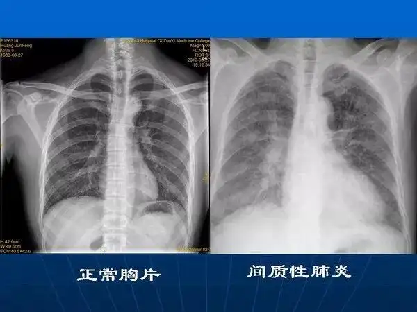 肺部感染性疾病的影像观察与分析