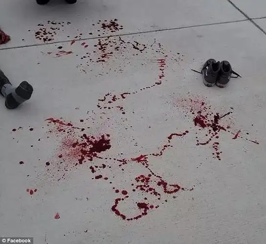 美国校园暴力严重, 残疾儿遭同学殴打, 母亲发血照谴责教师