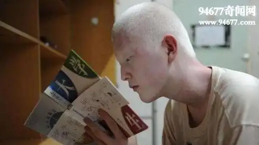 白化病能活多久,其实和正常人寿命一样(不能久晒)