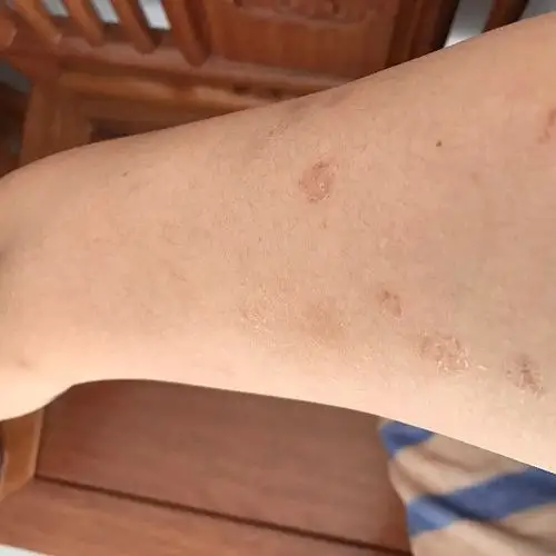 为什么一到冬天手臂上会起一块块小疙瘩泛红,起皮,抓了还会痒,夏天