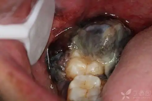 治疗经过:一个朋友亲戚,未见患者,发来照片,病检示 恶性黑色素瘤