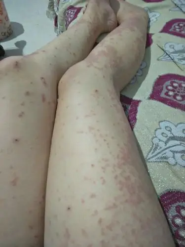 孕28周重度湿疹晚上睡不着谁有好办法呢?