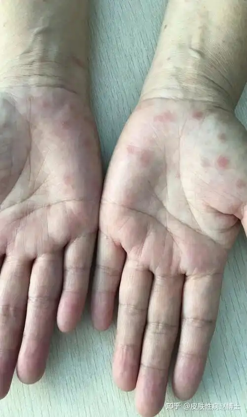 女子以为皮肤过敏来看急诊,结果竟是梅毒疹 - 知乎