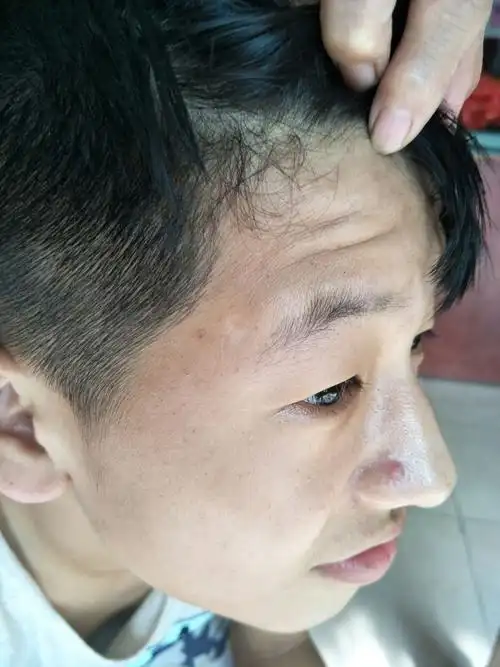 是一种常见多发的色素性皮肤病,是一种获得性或泛发性皮肤色素脱失症