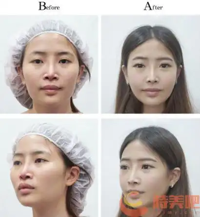 削骨手术有风险吗