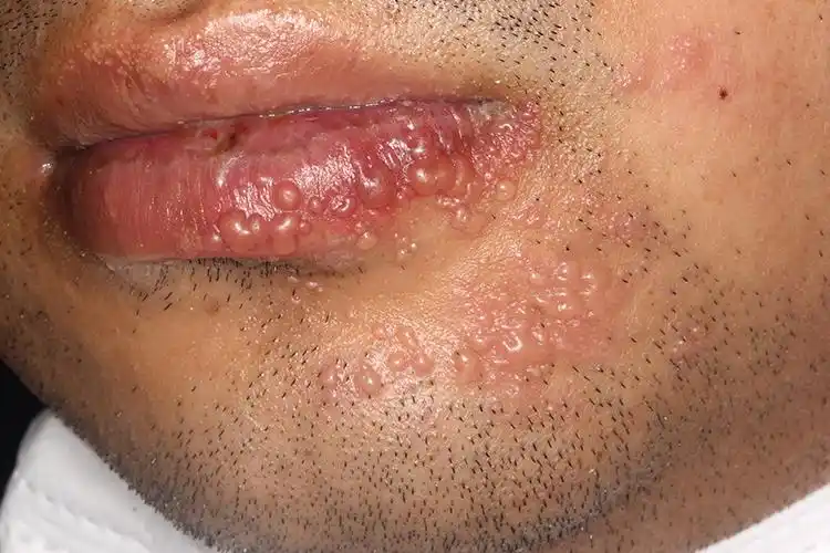 复发型单纯疱疹口周皮损图