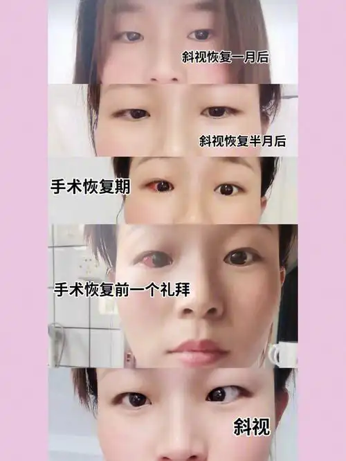 本人斜视手术记录