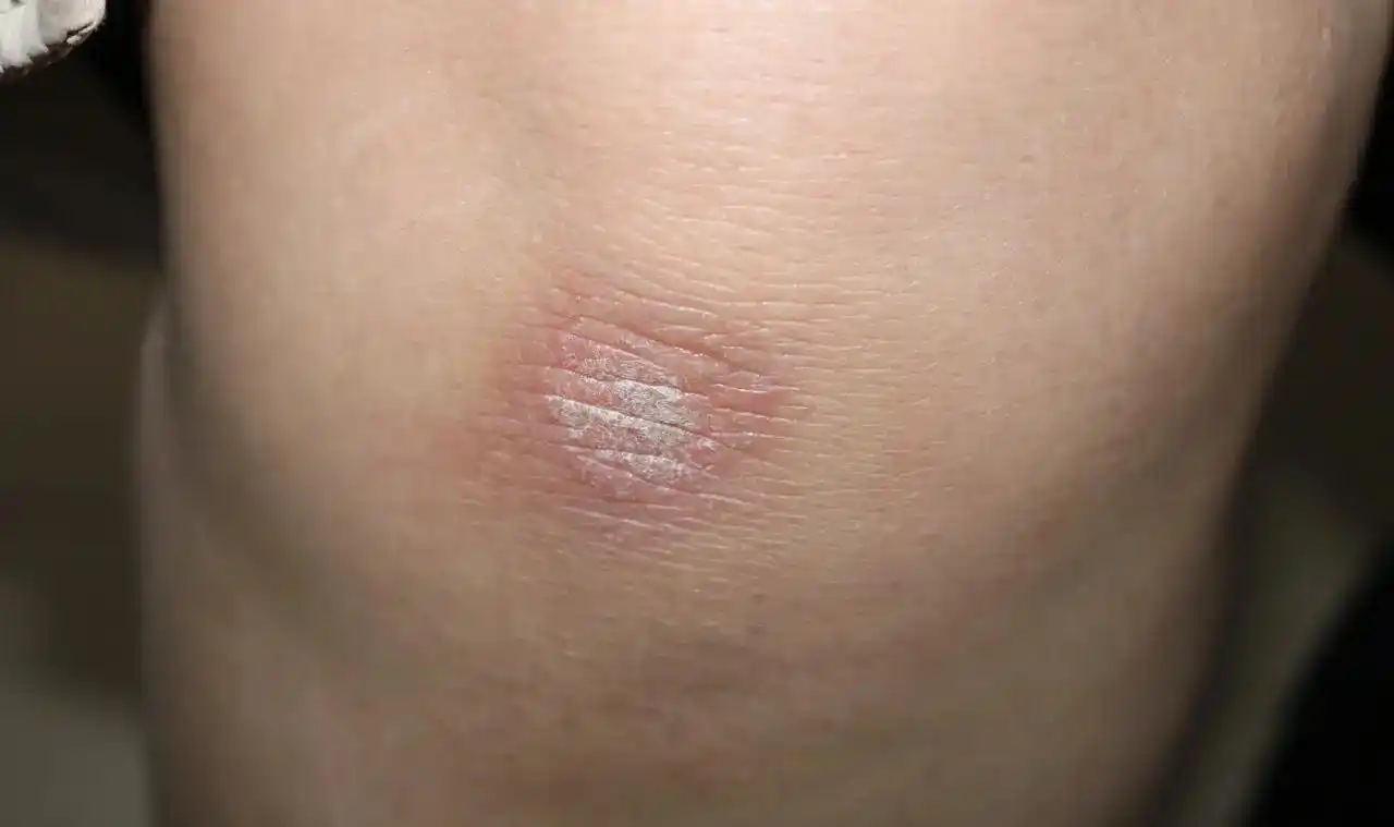 神经性皮炎怎么办