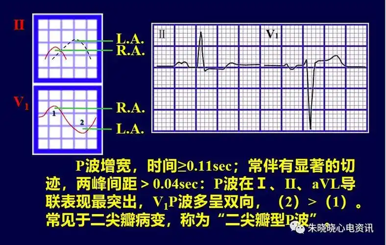 04秒;"二尖瓣型p波"多表现在Ⅰ,Ⅱ,avl,v4~v6导联;临床上多见于二尖瓣