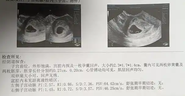 育儿战争——第二次孕早期检查带来的炸裂消息!_医生_双胞胎_时候