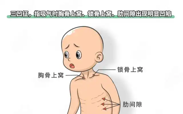 娃求救,你看不出来?咳嗽似狗叫 3大典型症状,有1个就危险