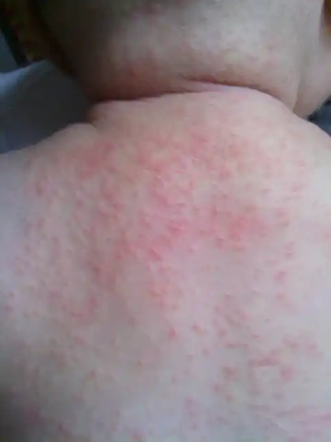 三个月宝宝,后背脖子长的不知道是什么东西,类似鸡皮疙瘩样的痱子