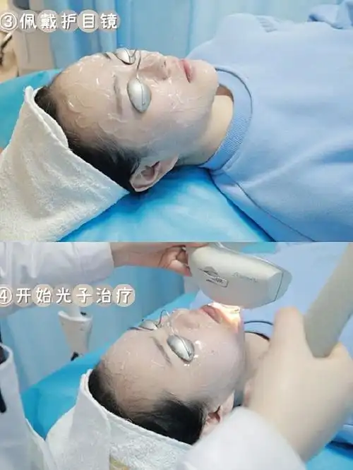 dpl超光子嫩肤初体验-效果出乎意料