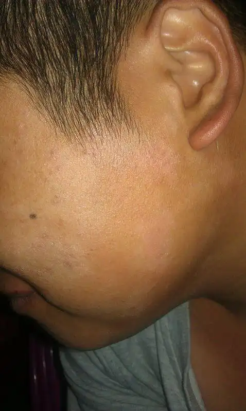 我老公的脸上皮肤为什么会长一块块白白的斑?