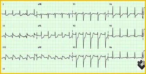 心肌梗塞心电图是怎样的?  急性心肌梗塞发作检查图