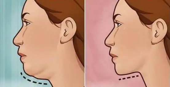 我终于理解什么是下颌后缩