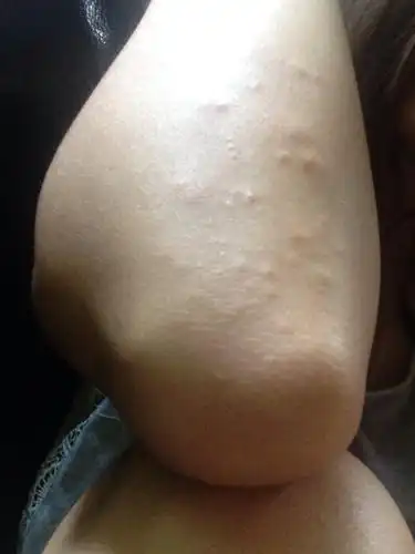 手肘上长了很多一点点的疹子,不痒不痛的.几个月都没有消退.