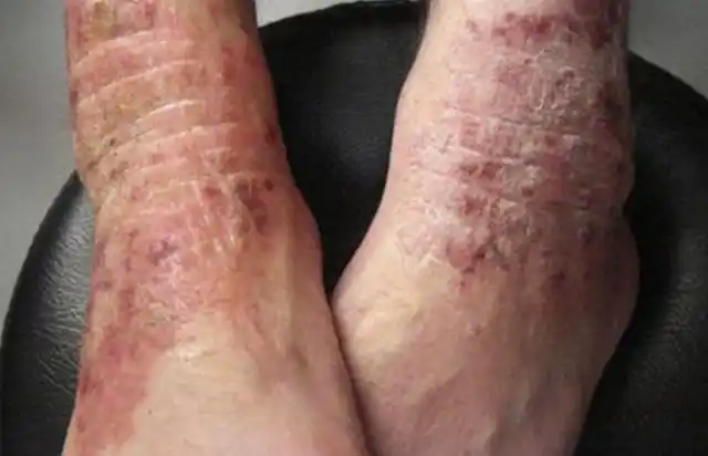 为何湿疹擦了药膏却更严重了?姜老太修肤堂告诉你