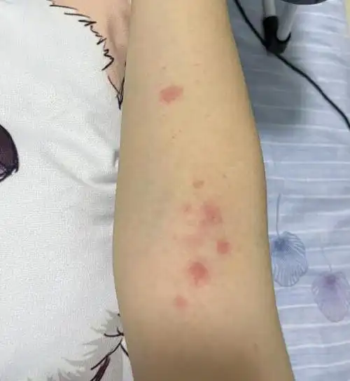 跳蚤咬的包和疤痕多久能消下去跳蚤咬的红疙瘩图片