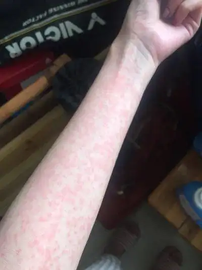 汗斑癣的治疗方法