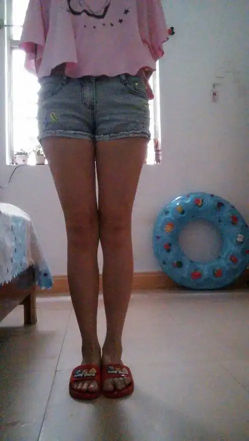 我这是x型腿吗?