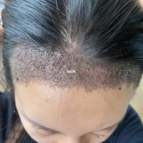 植发际线第4天