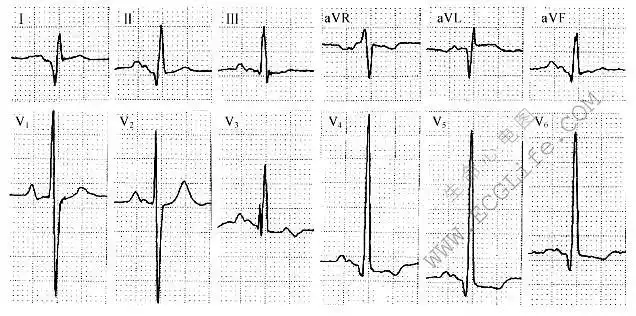 二尖瓣型p波心电图