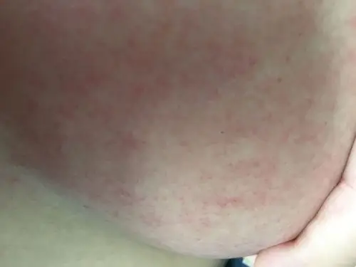 红,有点痒,但也不是痒的不行那种,穿刚买的衣服出门,斜挎的小包在胸前