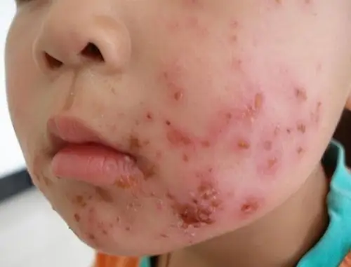这4种儿科常见皮炎你一定需要掌握