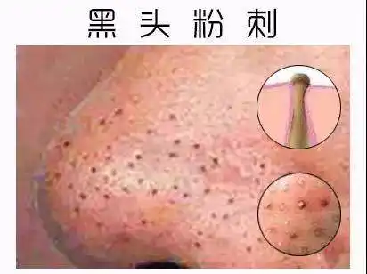 白头粉刺与黑头粉刺,傻傻分不清楚!