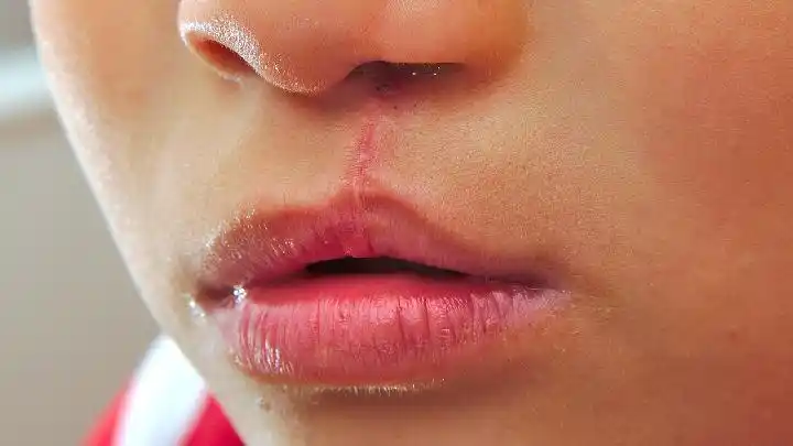 小儿兔唇的危害