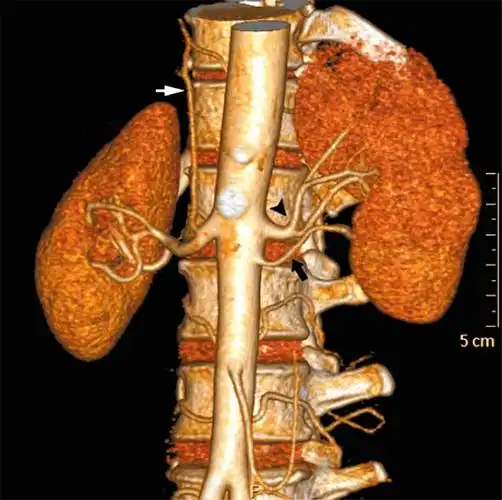 副肾动脉 accessory renal artery_血管_起始_左主