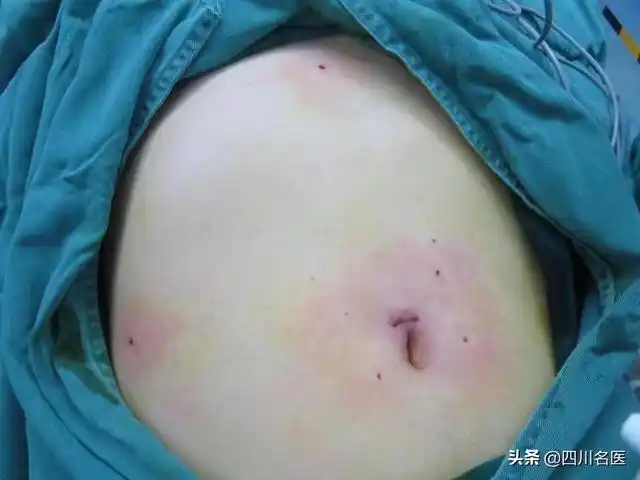 解锁无疤手术新选择!成都市六医院举行细径腹腔镜手术演示