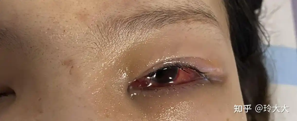 26岁女生做完斜视手术后的感受