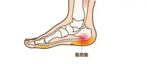 足跟痛又称跟痛症,跟骨痛,是由多种慢性疾病所致脚后跟部疼痛症候群
