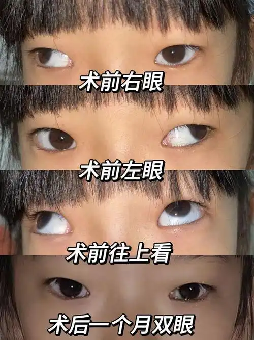 农村女孩患斜视综合征,多次寻医无果后在保山艾维眼科成功矫正|手术