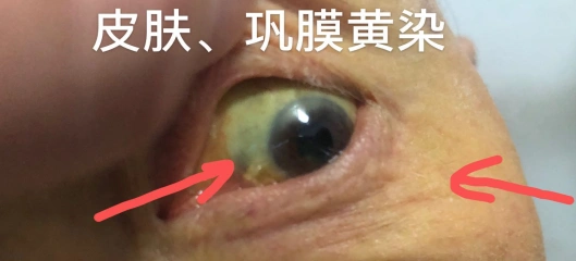 展开讲述之前我们先看看黄疸什么样,有图有真相
