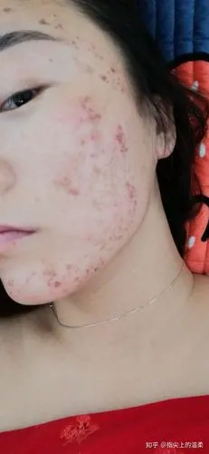 刷酸后结痂严重怎么办? - 知乎