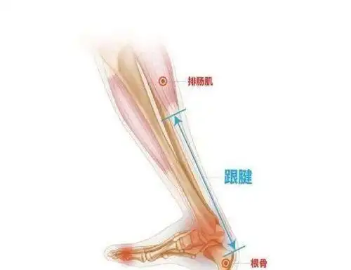 跟腱断裂围手术期康复指导